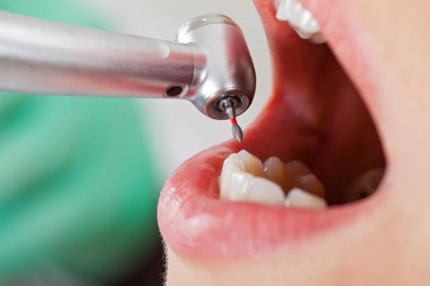 Best Emergency Tooth Extraction in Merkel, TX